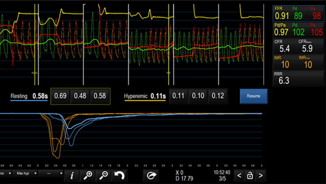 With Anoca Better To Test Coronary Function In Multiple Vessels